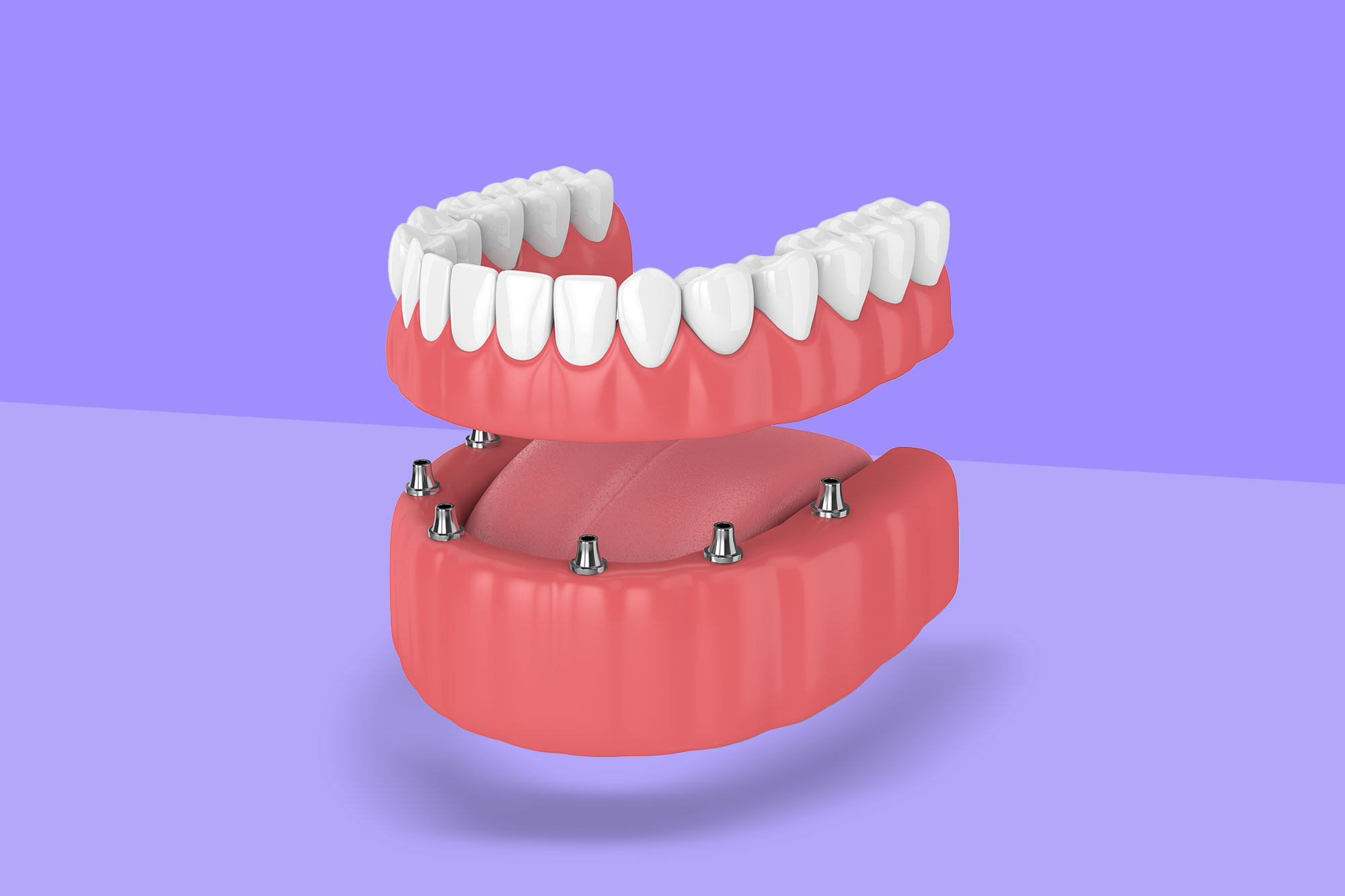A set of Hybrid Dentures