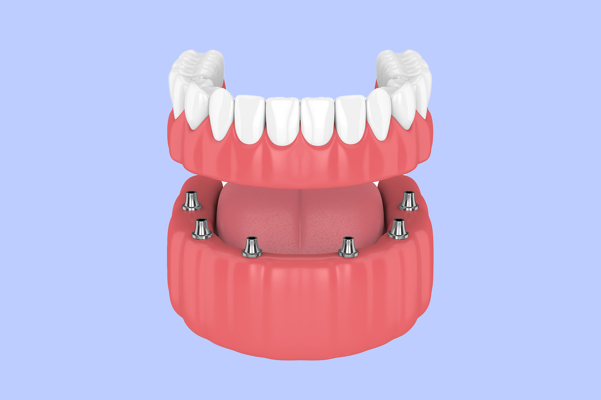 All-On-X Dental Implants