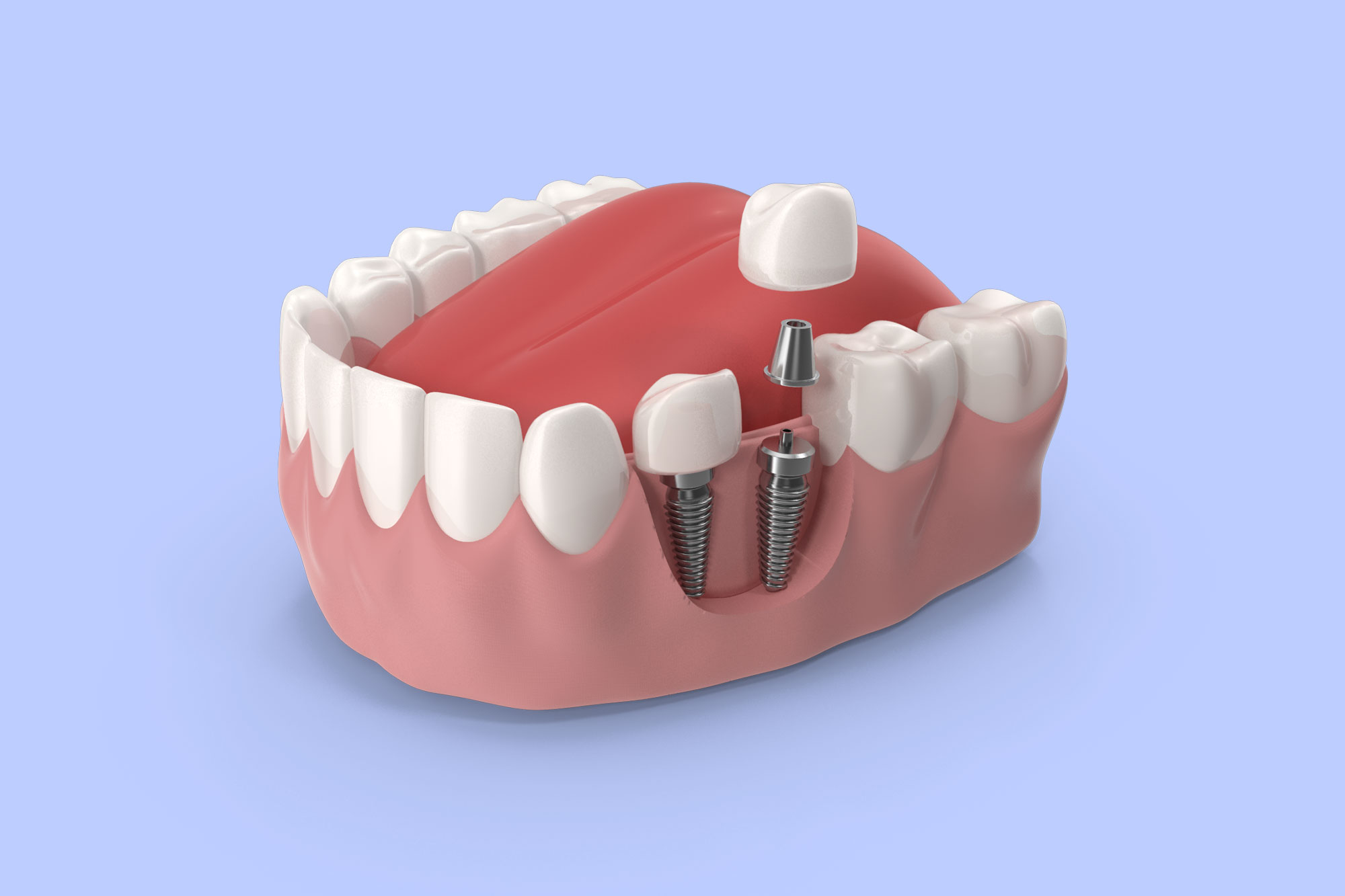 Dental Implants Miami