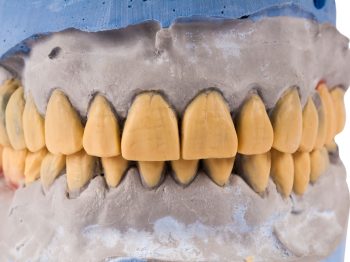 Acid in the teeth