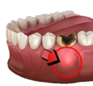 A Dental Abcess