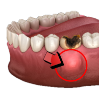 A Dental Abcess