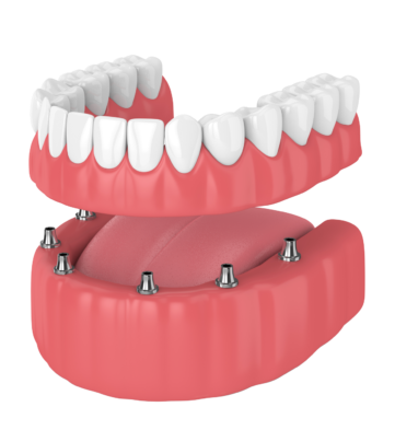 All On X Dental Implants Miami