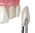 Cosmetic Veeners Miami