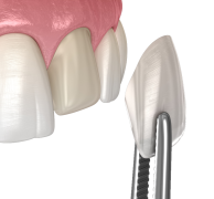 Cosmetic Veeners Miami